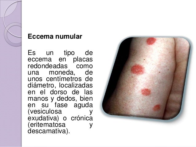 Los medios contra la psoriasis