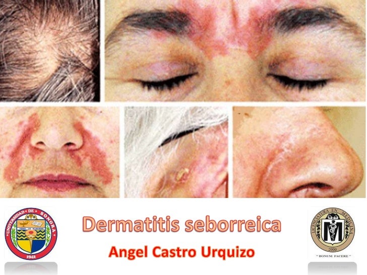 Il dispositivo per eliminazione di punti neri su una faccia
