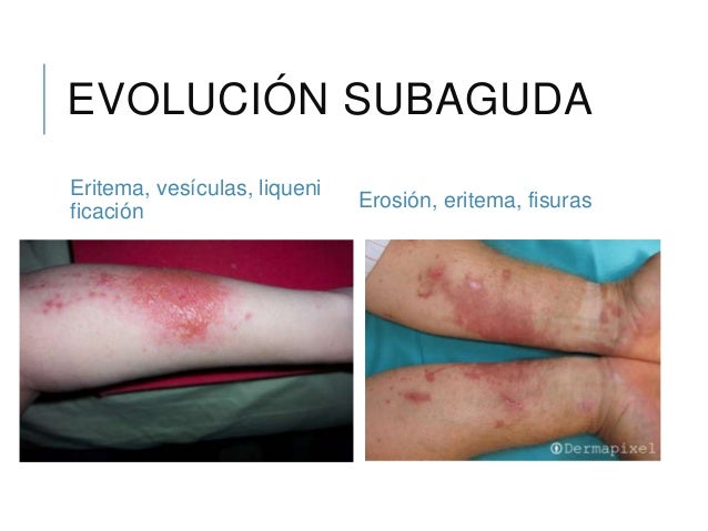 El tratamiento por los aceites la eccema la psoriasis