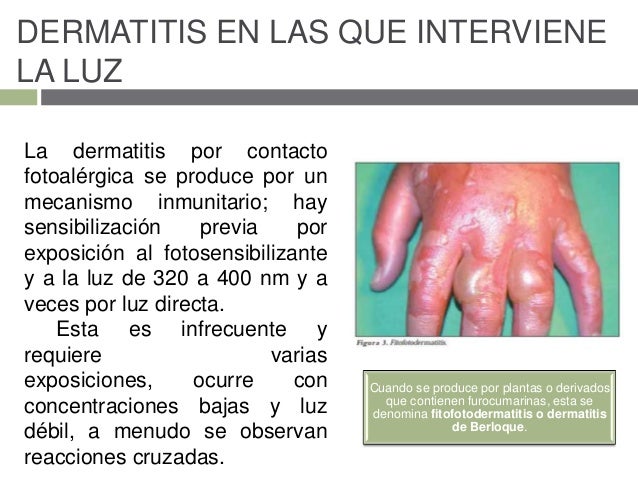 Si la psoriasis por los nervios