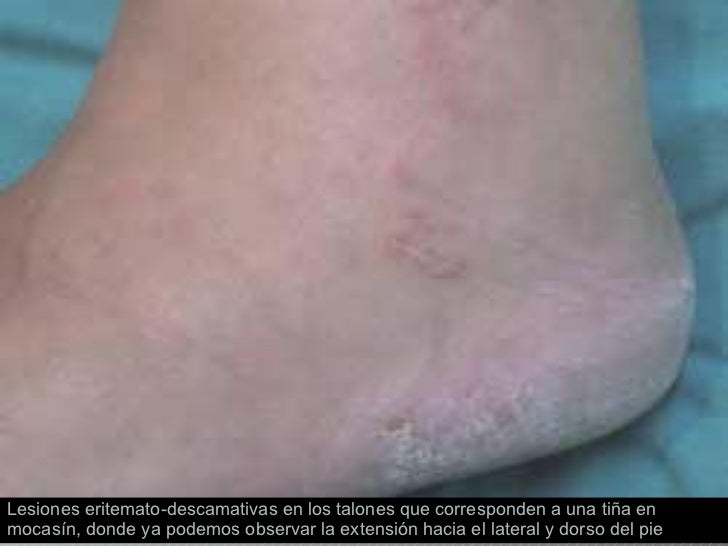 La psoriasis la crema el rey de la piel