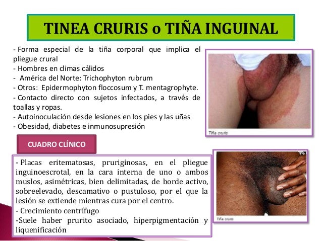 Hay cuanto un medio del hongo sobre la uña