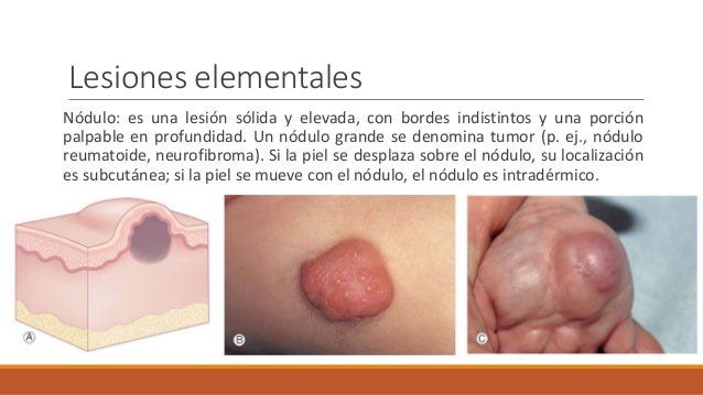 Conoceré quien está enfermo de la psoriasis