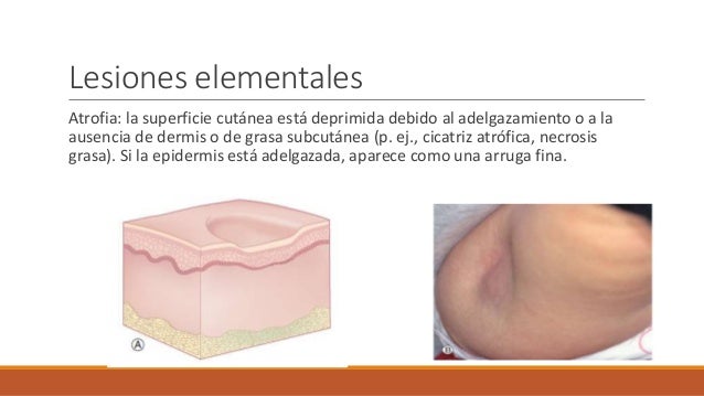 El uso del alquitrán de abedul a la psoriasis