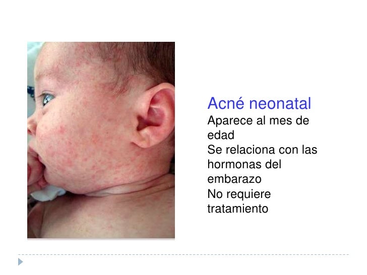 La foto la eccema a los niños