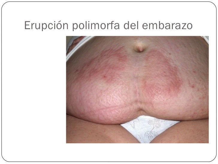 Que médico cura la psoriasis de las uñas