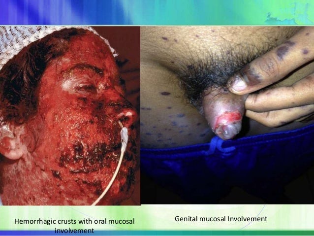 septic shock acute generalised exanthematous pustulosis Acute generalised exanthematous pustulosis mimicking eralized exanthematous pustulosis may mimic septic shock. septic shock acute generalised exanthematous pustulosis Acute generalised exanthematous pustulosis mimicking eralized exanthematous pustulosis may mimic septic shock.
