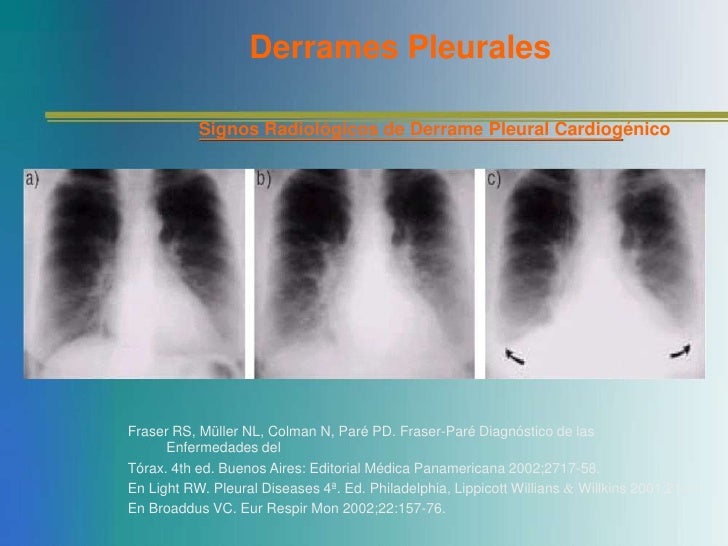 Derrame pleural