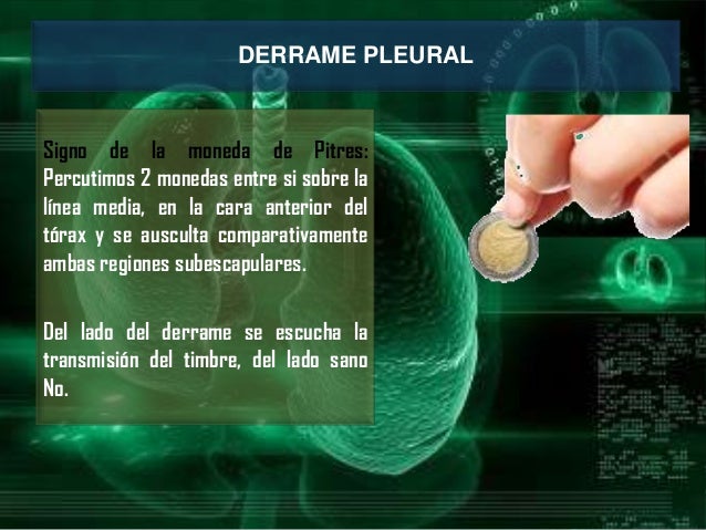 Derrame pleural