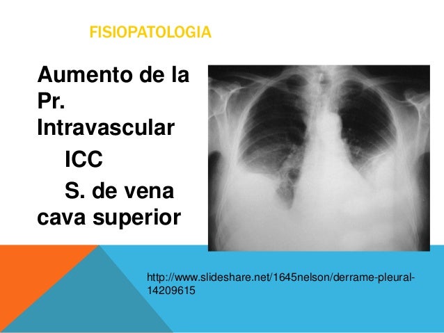 Derrame Pleural Fisiopatologia