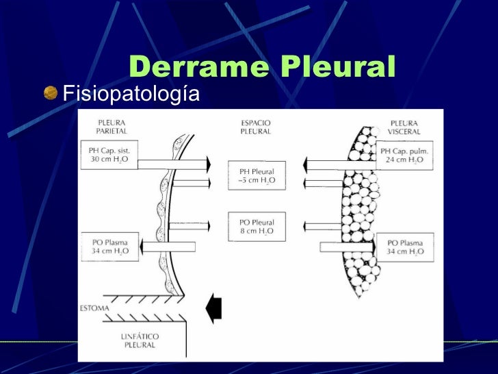 Derrame Pleural Maligno Pdf