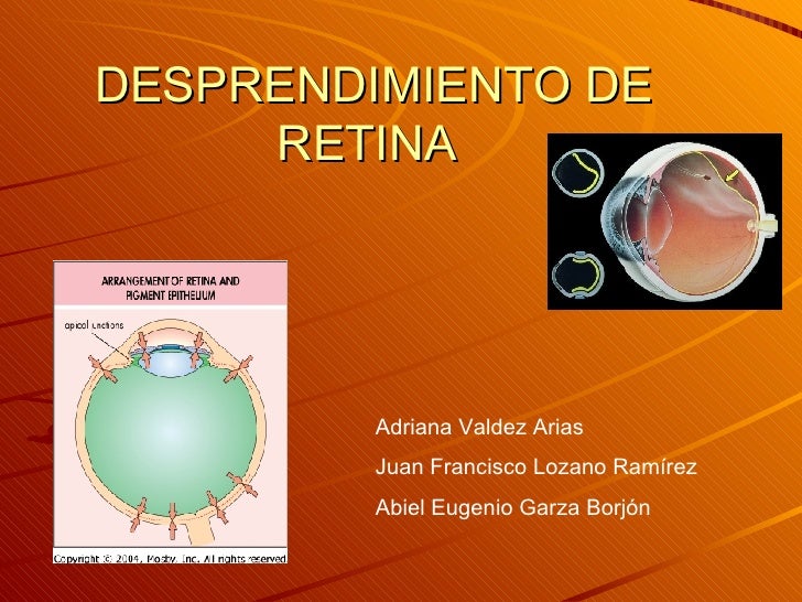 Desprendimiento De Retina Desprendimiento De Retina