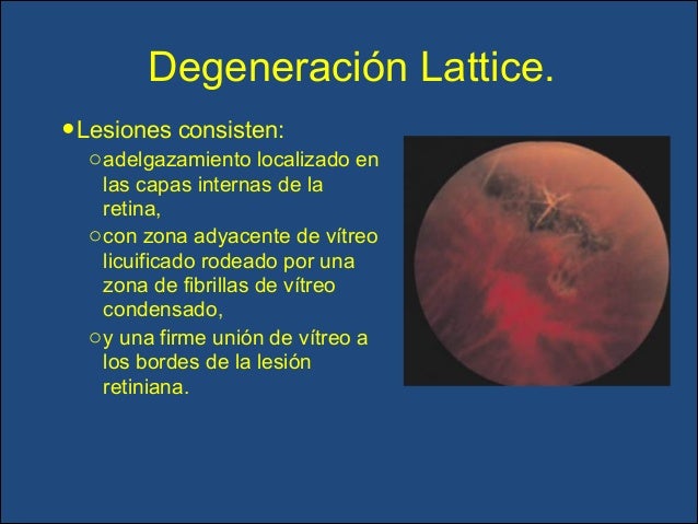 Lesiones Predisponentes A Desprendimiento De Retina es.slideshare.net