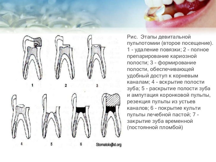 Пломбирование каналов зубов резорцином Пломбирование каналов зубов резорцином