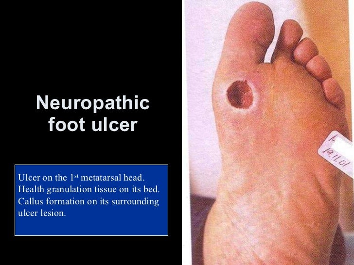 Diabetic related infection and management