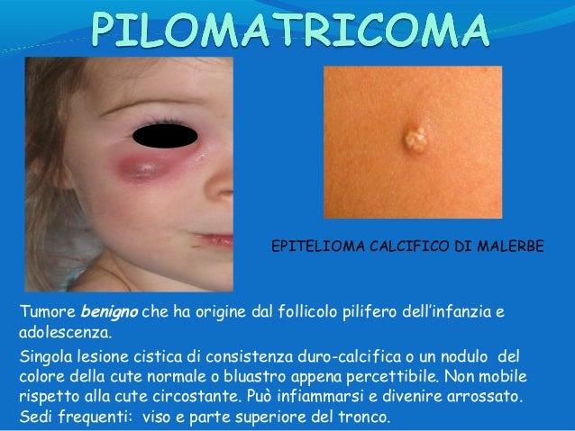 Sale di Epsom per psoriasi