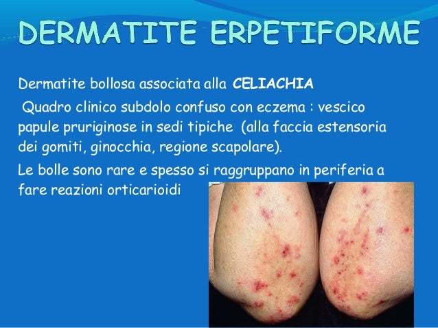 Eczema dopo la consegna alla testa