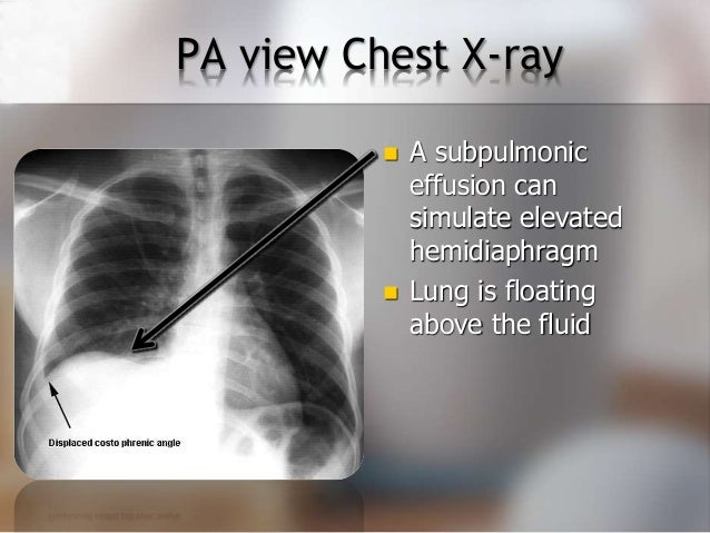 Pleural Fissure Thickening