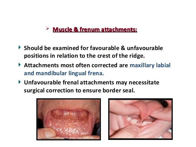 classification of edentulous ridge