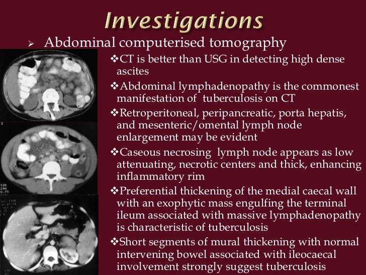 Diagnosis of abdominal tuberculosis
