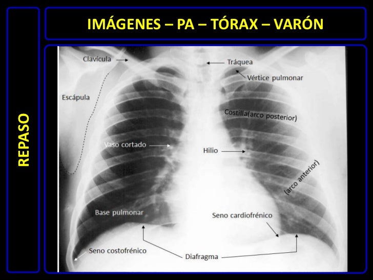 Diagnóstico por imágenes radiografía de tórax normal