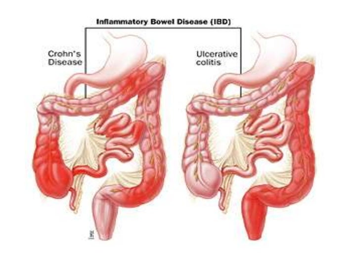 exercise and bowel obstruction pdf