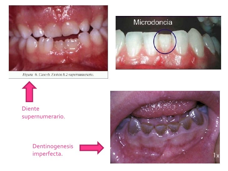 Dientes de turner