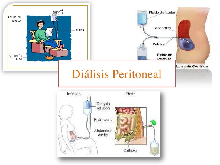 Peritoneal Dialysis Video