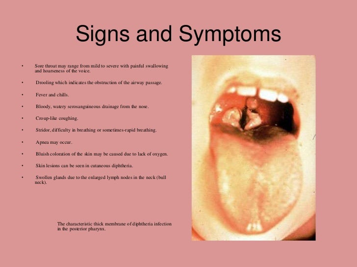 diphtheria - définition - What is