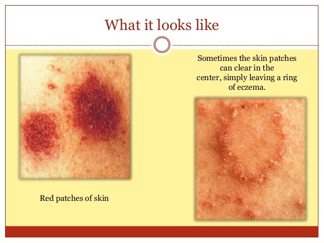 nummular eczema Picture Image on MedicineNet.com