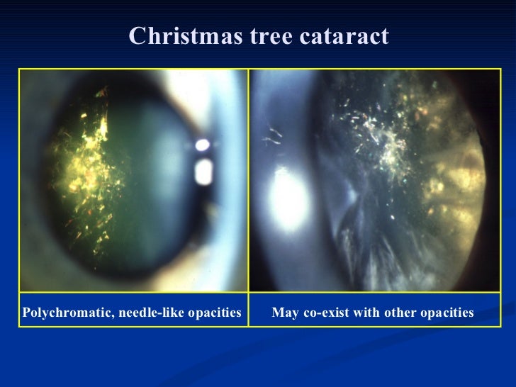 ophthalmology.Diseases of the lens.(dr.baxtyar)