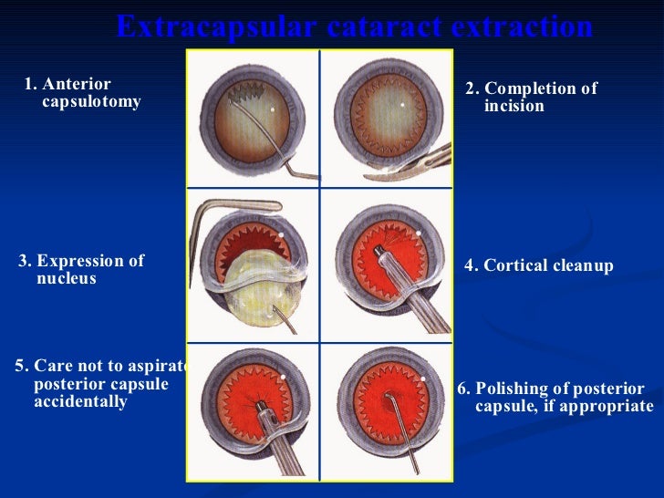 ophthalmology.Diseases of the lens.(dr.baxtyar)