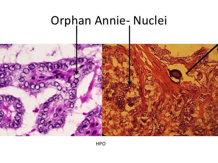 Recent advances in remedy of cervical cancer cervical cancer remedy nccn