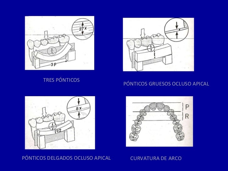 Tipos De Ponticos En Protesis Fija www.slideshare.net
