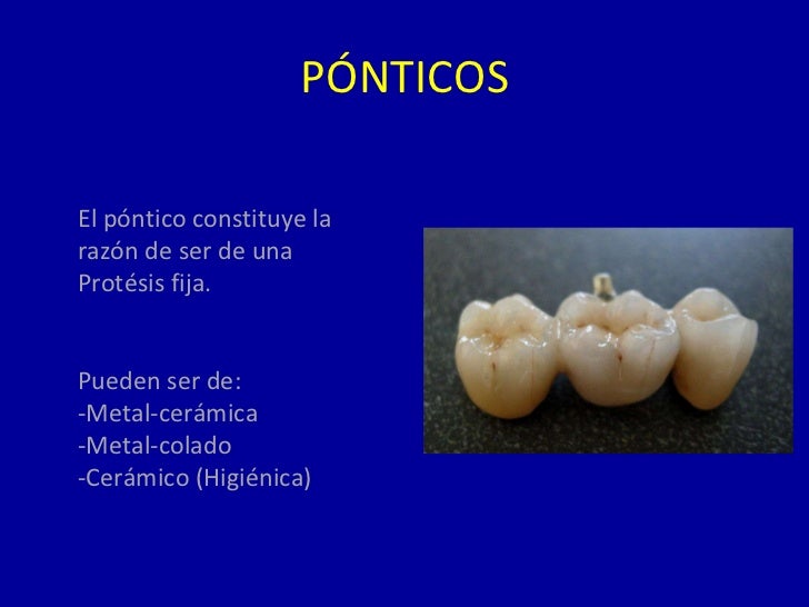 Tipos De Ponticos En Protesis Fija es.slideshare.net