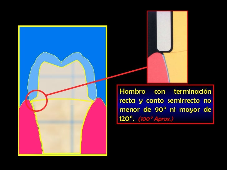 Diseño de protesis parcial fija 2