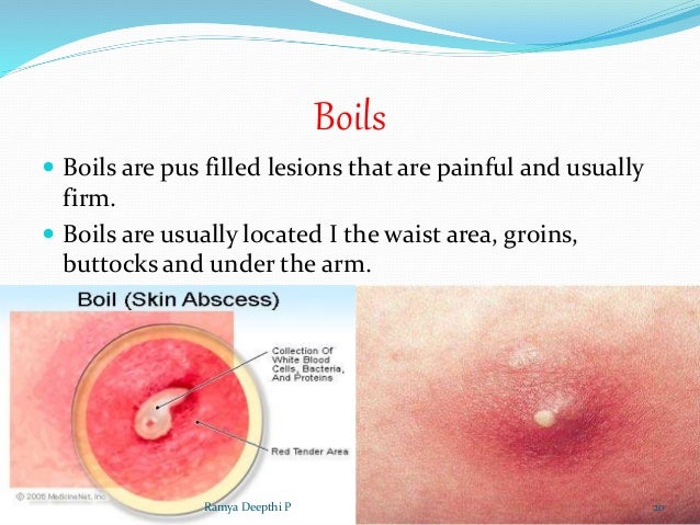 Boils: Facts About Treatments, Home Remedies, and Causes