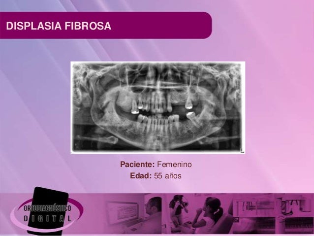 Displasia fibrosa