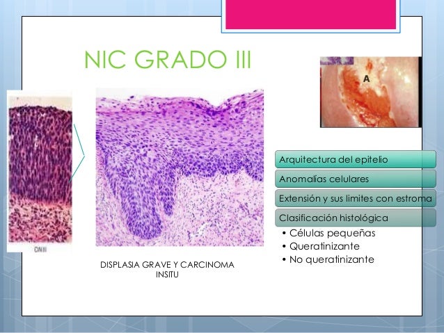 Displasias o nic