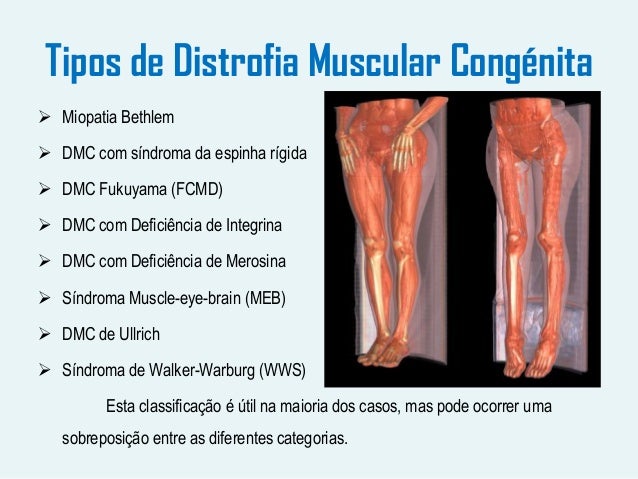 Distrofia muscular congénita