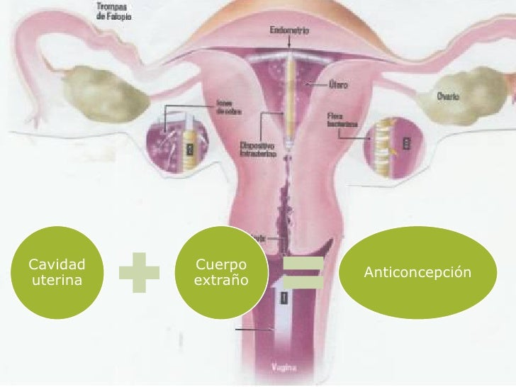 DISPOSITIVO INTRAUTERINO DIU