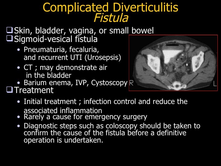 Diverticulitis