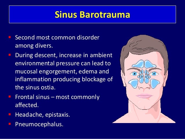 sinus barotrauma healing time sinus barotrauma healing time