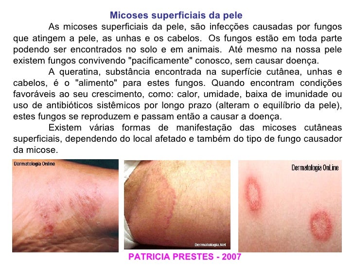 Como curar um fungo em um dedo