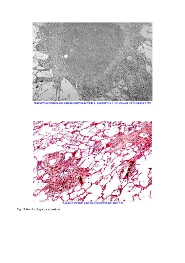 mesothelioma existence expectancy signs