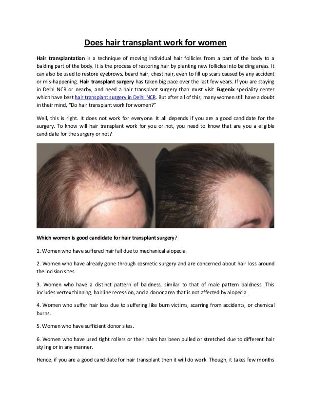 does hair of the work does hair transplant work for does hair of the work does hair transplant work for