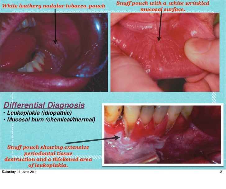 D of keratotic white lesions