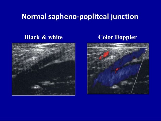 Doppler ultrasound in deep vein thrombosis