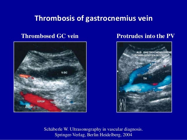 Doppler ultrasound in deep vein thrombosis