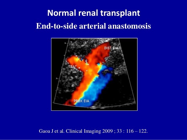 Doppler ultrasound in transplant renal artery stenosis